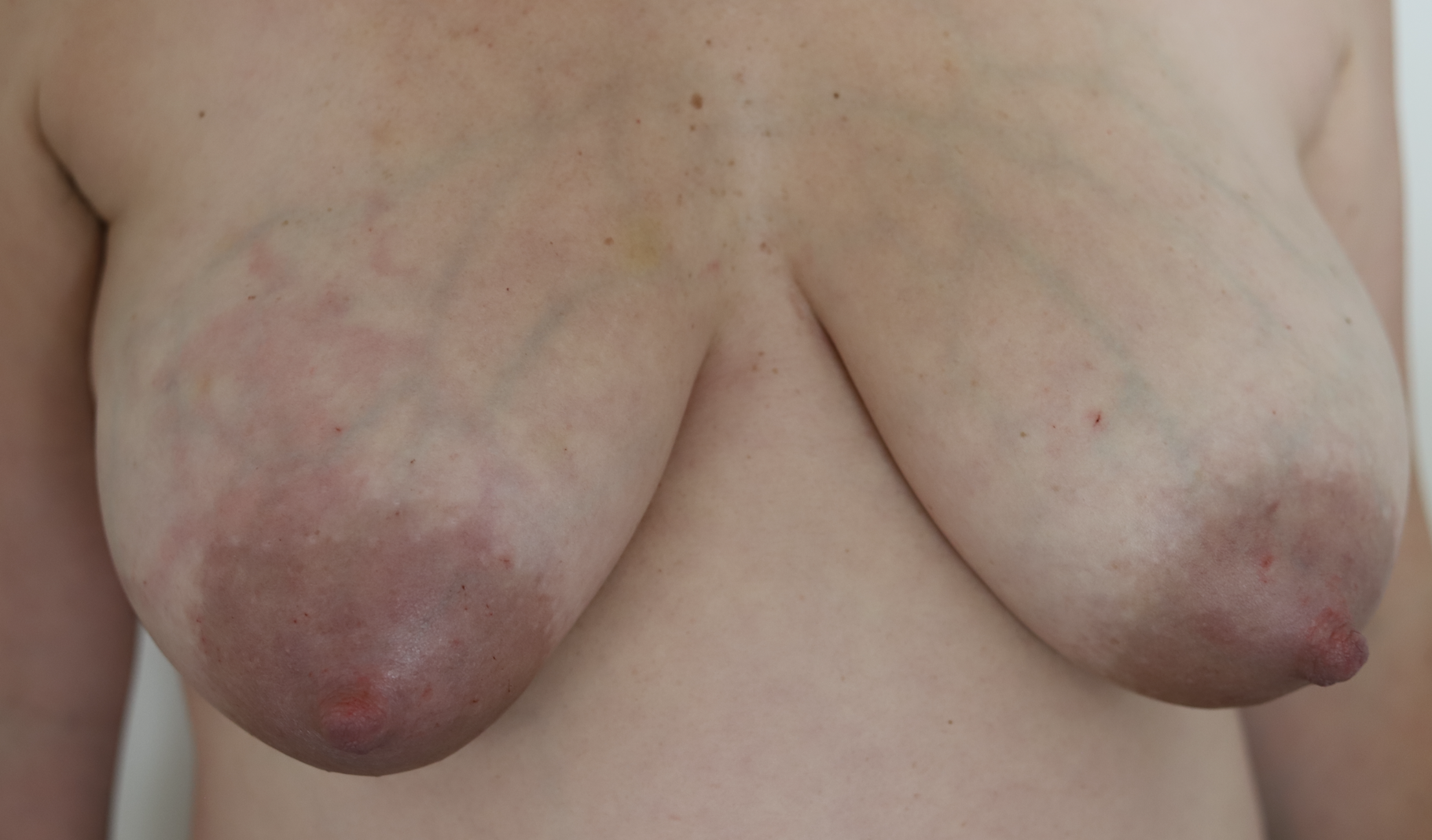 Early mastitis with streaking